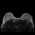 Breast implants - MRI (Radiopaedia 26864-27035 Axial T2 16).jpg