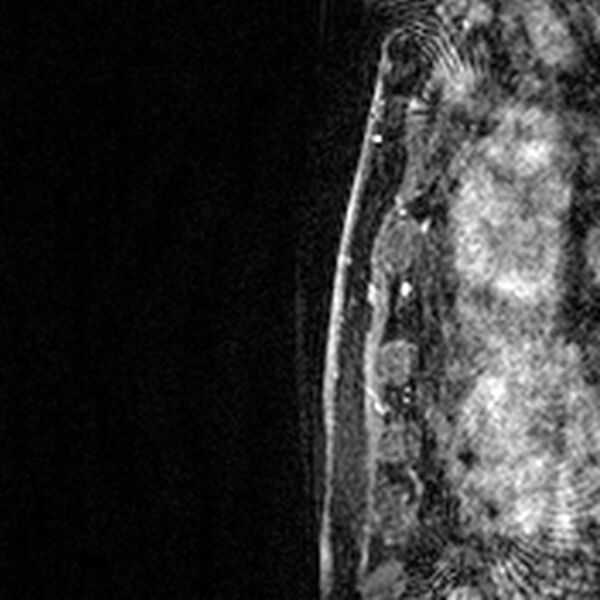 File:Breast implants - MRI (Radiopaedia 26864-27035 Sagittal T2 71).jpg