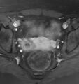 Broad ligament leiomyoma (Radiopaedia 81634-95516 Axial T1 C+ fat sat 15).jpg
