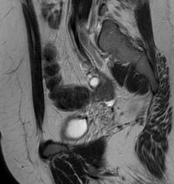 File:Broad ligament leiomyoma (Radiopaedia 81634-95516 Sagittal T2 21).jpg