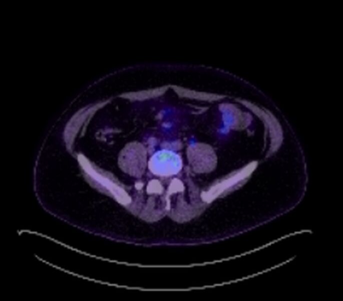 File:Bronchial carcinoid tumor (Radiopaedia 67377-76766 18FDG-PET-CT 51).jpg