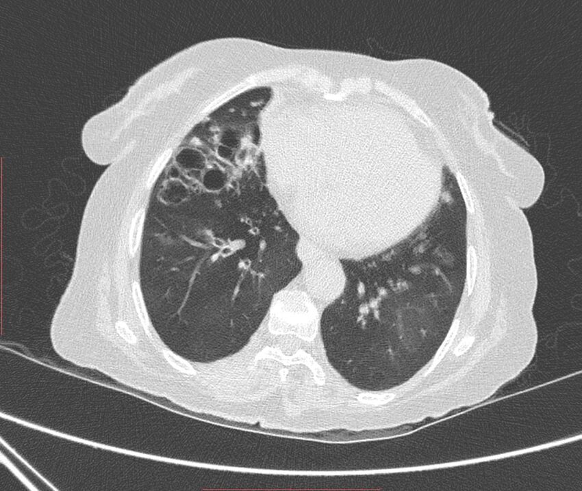 Bronchiectasis (Radiopaedia 72693-83293 Axial lung window 91).jpg