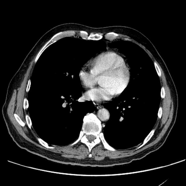File:Bronchogenic carcinoma with L1 vertebra metastasis (Radiopaedia 9096-9805 Axial C+ delayed 21).jpg