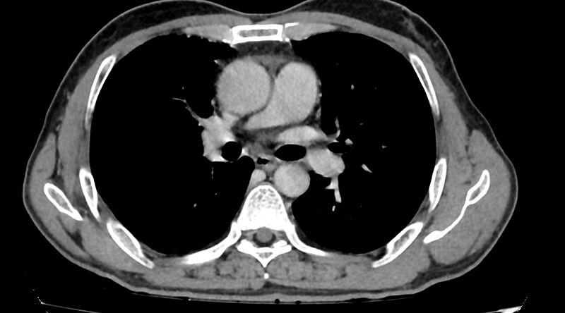 File:Bronchogenic carcinoma with superior vena cava syndrome (Radiopaedia 36497-38054 Axial C+ delayed 46).jpg
