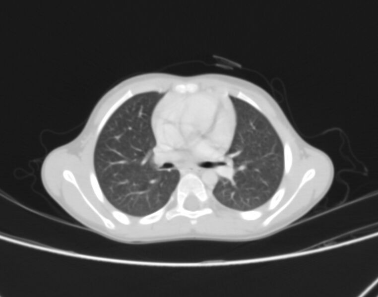 File:Bronchus suis (Radiopaedia 68131-77620 Axial lung window 36).jpg
