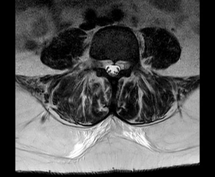 File:Brown tumors compressing the spinal cord (Radiopaedia 68442-78030 Axial T2 - lumbar 22).jpg