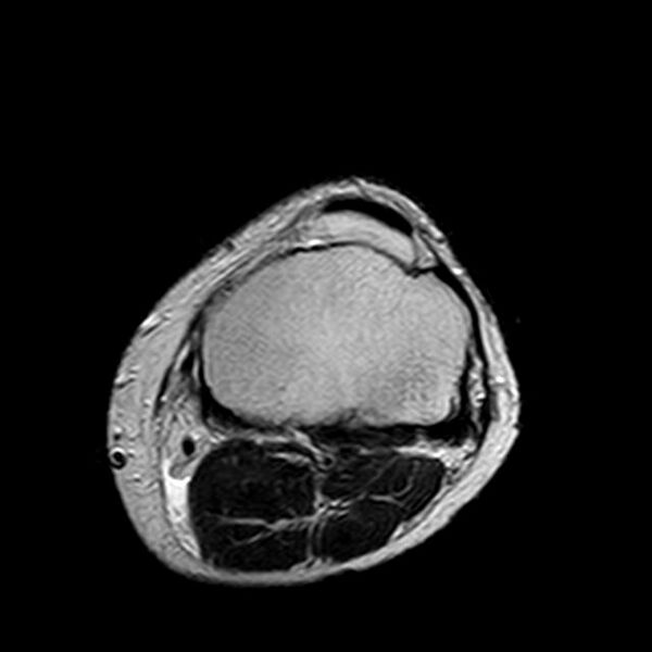 File:Bucket handle tear - medial meniscus (Radiopaedia 29250-29664 Axial T2 3).jpg