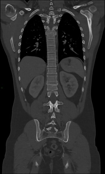 File:Burst fracture (Radiopaedia 83168-97542 Coronal bone window 51).jpg