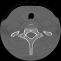 C5 facet fracture (Radiopaedia 58374-65499 Axial bone window 79).jpg