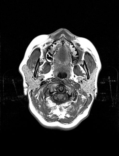 File:Calcified cerebral hydatid cyst (Radiopaedia 65603-74699 Axial T1 1).jpg