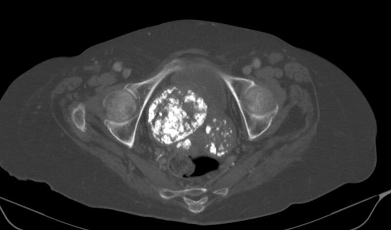 File:Calcified fibroids (Radiopaedia 20306-20228 Axial bone window 20).jpg