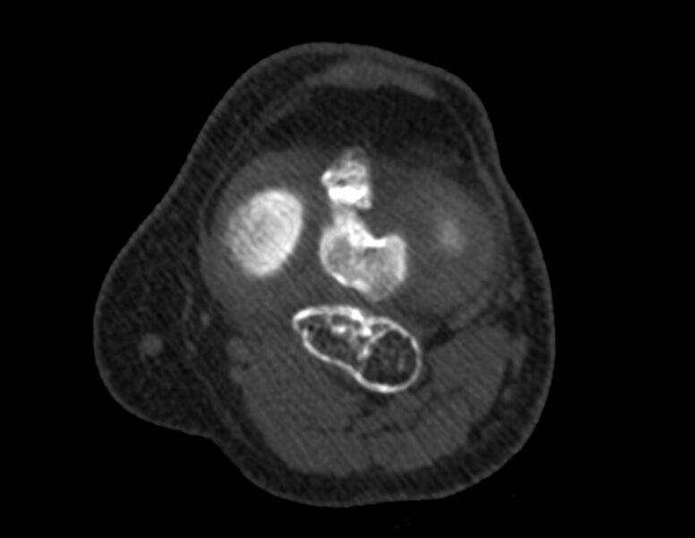 File:Calcified hematoma - popliteal fossa (Radiopaedia 63938-72763 Axial bone window 24).jpg