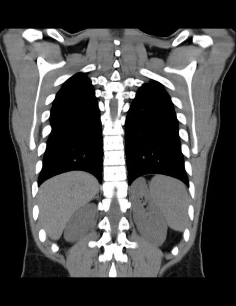 File:Calcifying pulmonary metastases (Radiopaedia 33359-34396 Coronal non-contrast 11).jpg