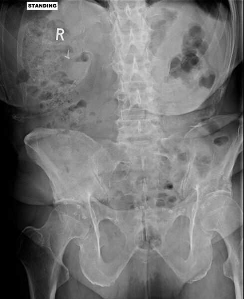 File:Camptocormia (bent spine syndrome) (Radiopaedia 46104-50456 C 1).JPG