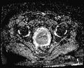 Cancer cervix - stage IIb (Radiopaedia 75411-86615 Axial ADC 9).jpg