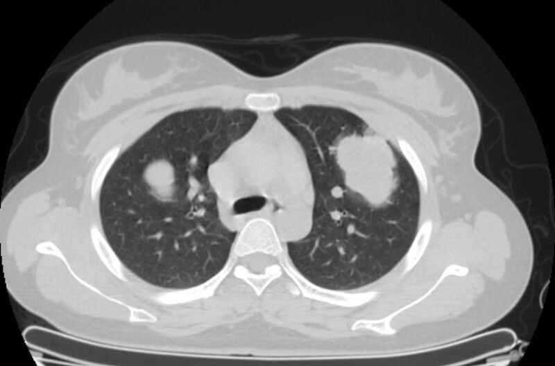 File:Cannonball metastases - uterine choriocarcinoma (Radiopaedia 70137-80173 Axial lung window 24).jpg