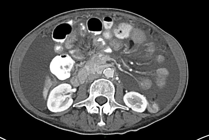 File:Carcinoid mesenteric tumor complicated by chylous ascites (Radiopaedia 76312-87953 A 35).jpg