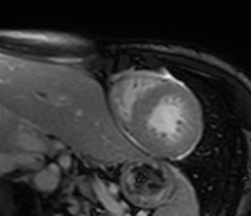 Cardiac amyloidosis (Radiopaedia 39736-42124 F 144).jpg
