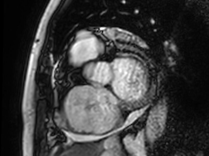 File:Cardiac amyloidosis (Radiopaedia 61600-69579 Short axis bSSFP 306).jpg