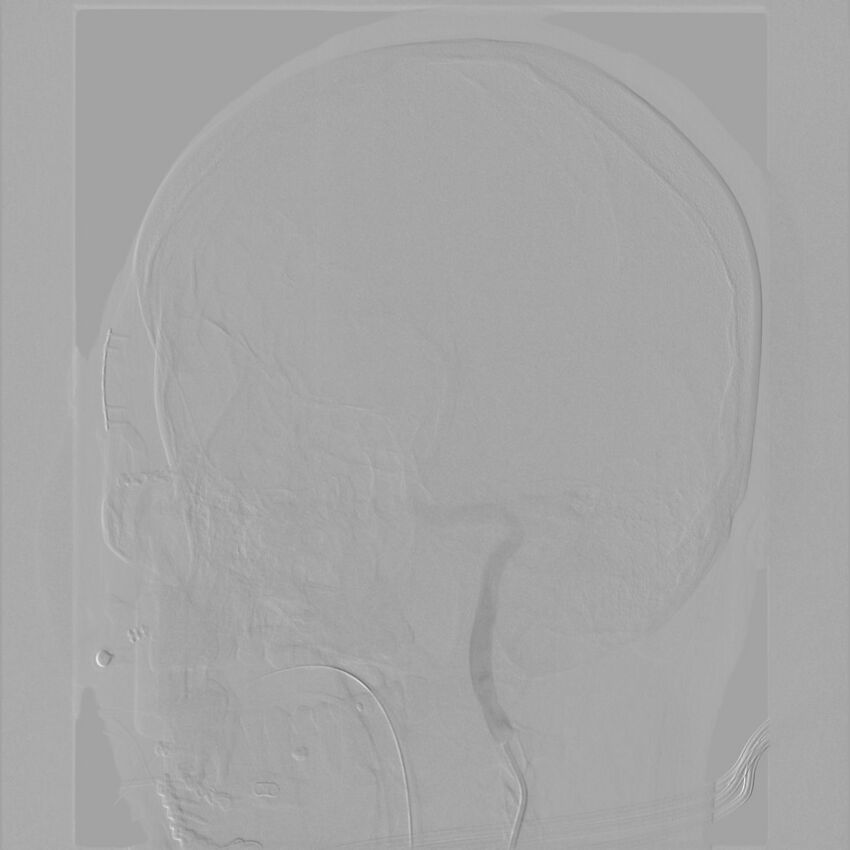 Caroticocavernous fistula - direct (Radiopaedia 61660-69666 Oblique Left ICA 10).jpg