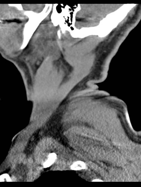 File:Cavernoma of cervical cord (Radiopaedia 50838-56346 B 5).png