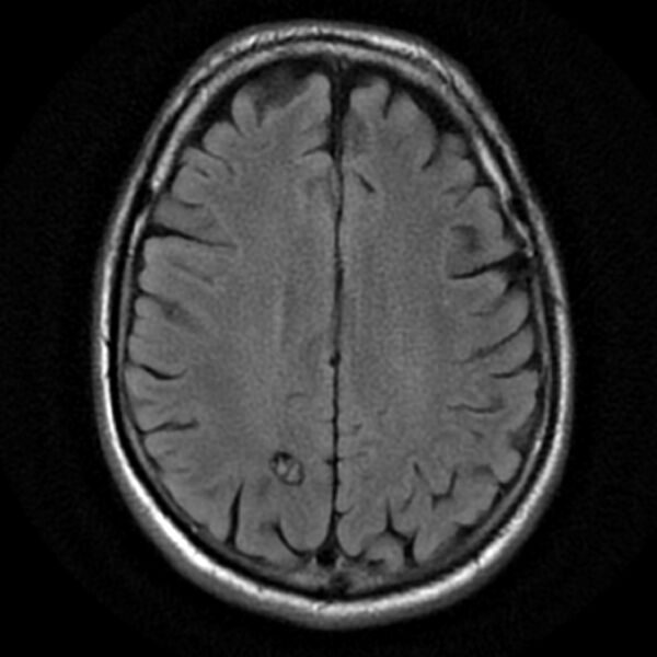 File:Cavernous hemangioma - brain (Radiopaedia 9773-10378 Axial FLAIR 1).jpg