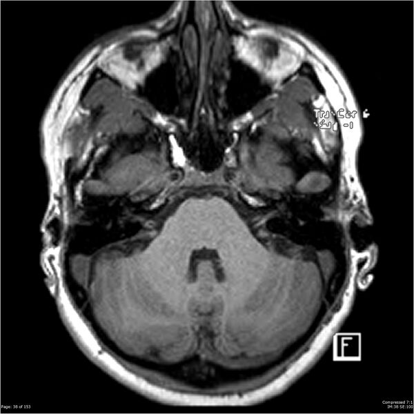 File:Cavernous malformation (cavernous angioma or cavernoma) (Radiopaedia 36675-38237 Axial T1 27).jpg