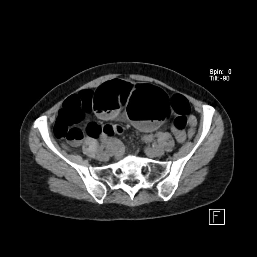 Cecal volvulus (Radiopaedia 90897-108397 Axial non-contrast 47).jpg