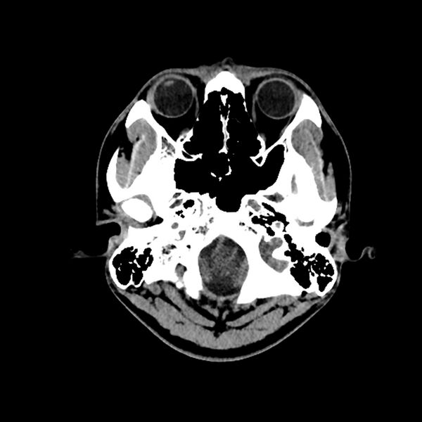 File:Central neurocytoma (Radiopaedia 79320-92379 Axial non-contrast 6).jpg