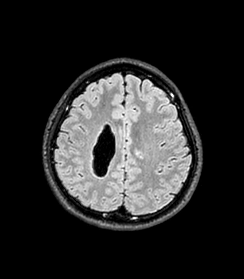 Central neurocytoma (Radiopaedia 79320-92380 Axial FLAIR 96).jpg