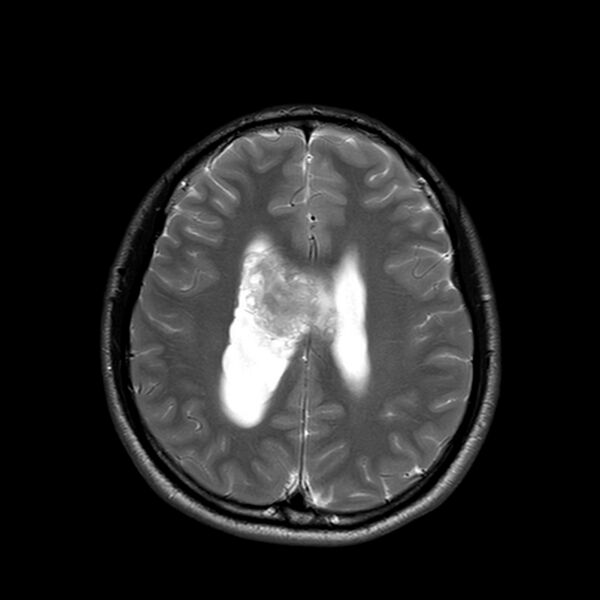 File:Central neurocytoma (Radiopaedia 79320-92380 Axial T2 19).jpg