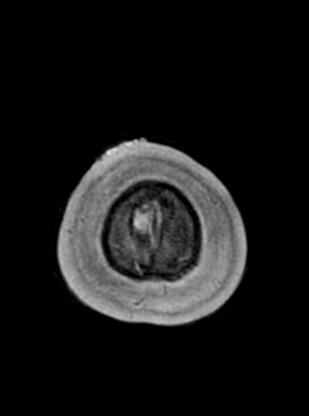 File:Central neurocytoma (Radiopaedia 79320-92381 Axial T1 43).jpg