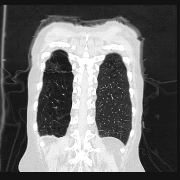 File:Centrilobular pulmonary emphysema (Radiopaedia 24495-24789 Coronal lung window 67).jpg