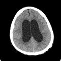 Cerebellar abscess secondary to mastoiditis (Radiopaedia 26284-26412 Axial non-contrast 107).jpg