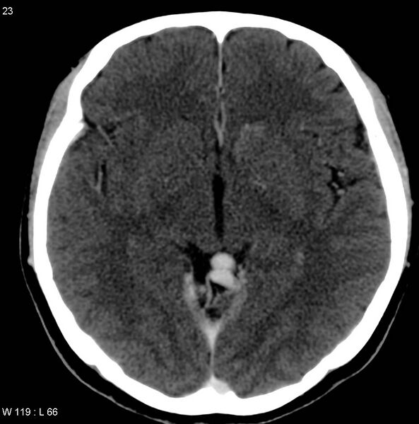 File:Cerebellar arteriovenous malformation (Radiopaedia 5220-36607 A 10).jpg
