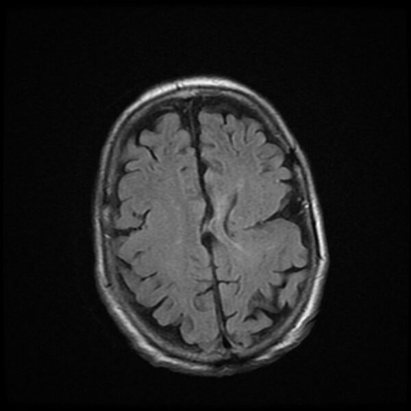 File:Cerebellar metastasis - lung tumor (Radiopaedia 69317-79147 Axial FLAIR 5).jpg