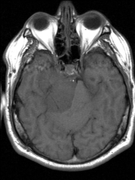 File:Cerebellopontine angle meningioma (Radiopaedia 24459-24764 Axial T1 7).jpg
