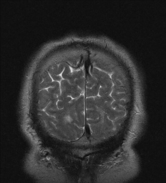 File:Cerebellopontine angle meningioma (Radiopaedia 24459-24764 Coronal T2 24).jpg