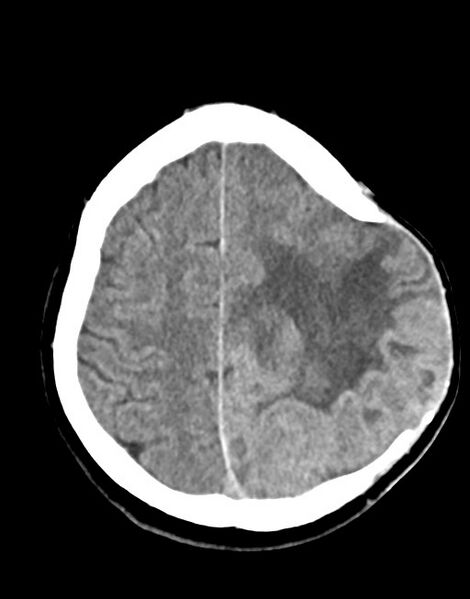 File:Cerebral abscesses (Radiopaedia 70458-80568 Axial non-contrast 47).jpg