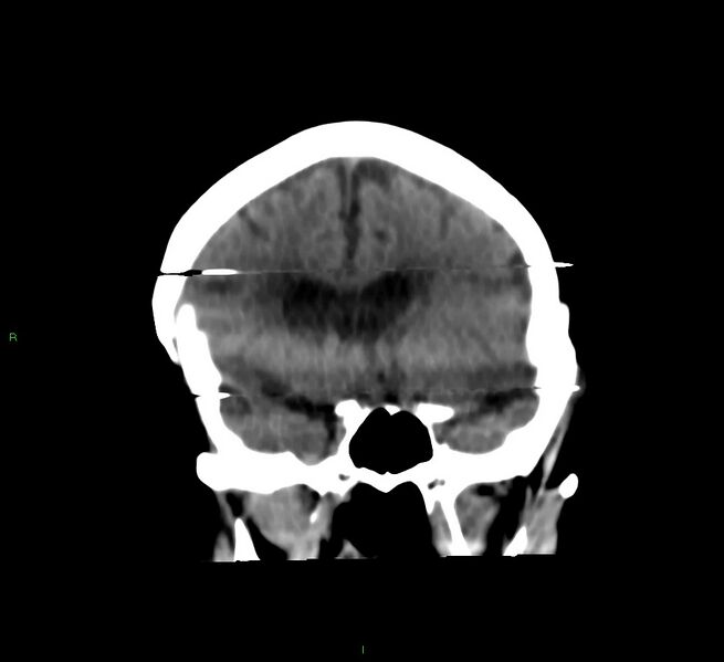 File:Cerebral amyloid angiopathy-associated lobar intracerebral hemorrhage (Radiopaedia 58377-65514 Coronal non-contrast 43).jpg