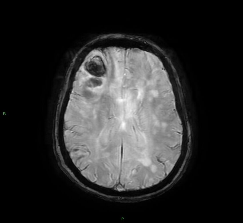 Cerebral amyloid angiopathy-associated lobar intracerebral hemorrhage (Radiopaedia 58378-65517 Axial SWI 45).jpg
