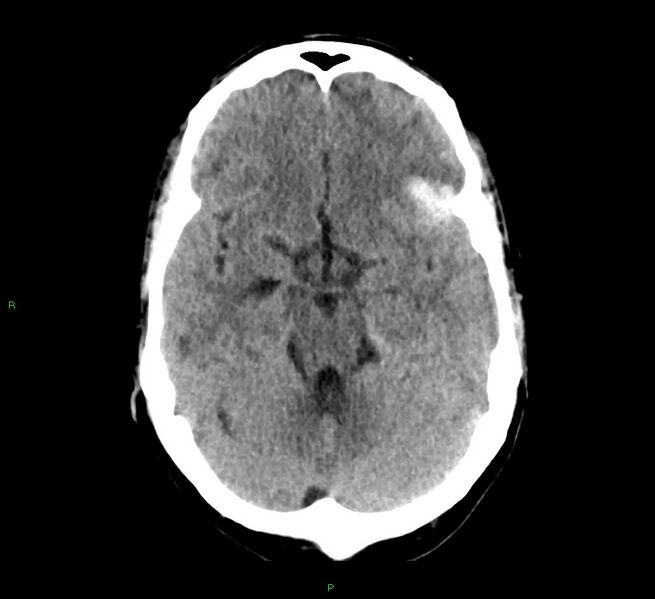 File:Cerebral amyloid angiopathy-associated lobar intracerebral hemorrhage (Radiopaedia 58529-65687 Axial non-contrast 34).jpg