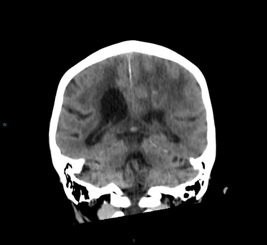 Cerebral amyloid angiopathy-associated lobar intracerebral hemorrhage (Radiopaedia 58530-65688 Coronal non-contrast 27).jpg