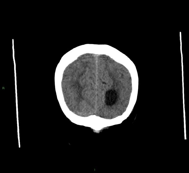 File:Cerebral amyloid angiopathy-associated lobar intracerebral hemorrhage (Radiopaedia 58560-65723 Coronal non-contrast 12).jpg