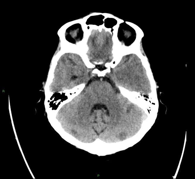 File:Cerebral amyloid angiopathy-associated lobar intracerebral hemorrhage (Radiopaedia 58566-65731 Axial non-contrast 7).jpg