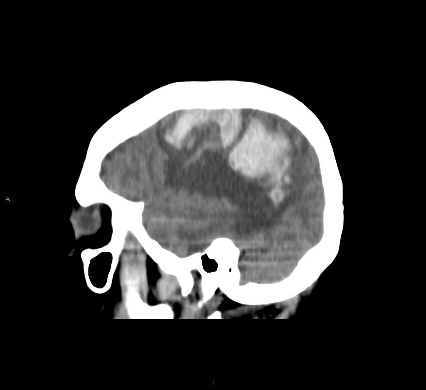 Cerebral amyloid angiopathy-associated lobar intracerebral hemorrhage (Radiopaedia 58751-65972 C 15).jpg