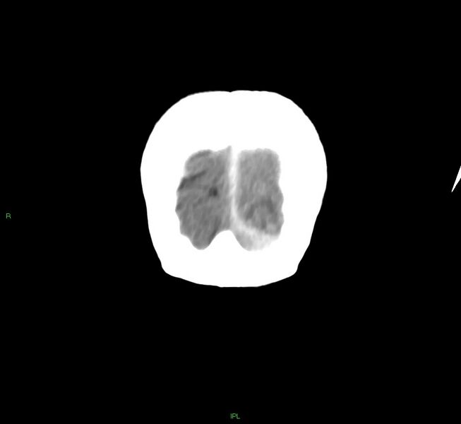 File:Cerebral amyloid angiopathy-associated lobar intracerebral hemorrhage (Radiopaedia 58754-65975 Coronal non-contrast 7).jpg