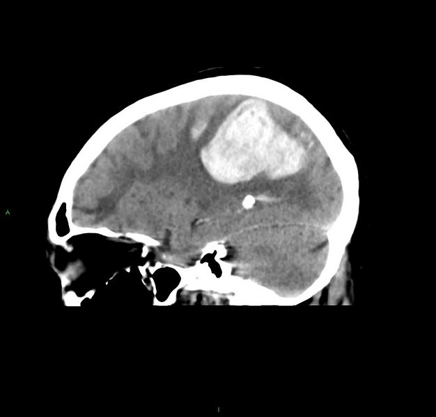 File:Cerebral amyloid angiopathy-associated lobar intracerebral hemorrhage (Radiopaedia 59356-66716 C 20).jpg