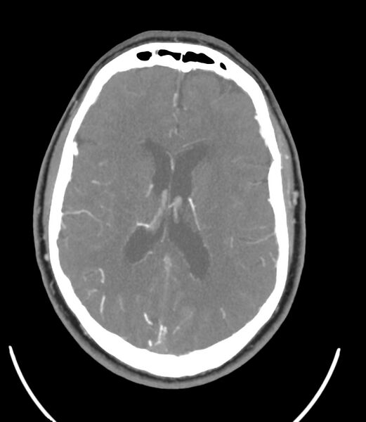 File:Cerebral dural venous sinus thrombosis (Radiopaedia 86514-102576 A 62).jpg