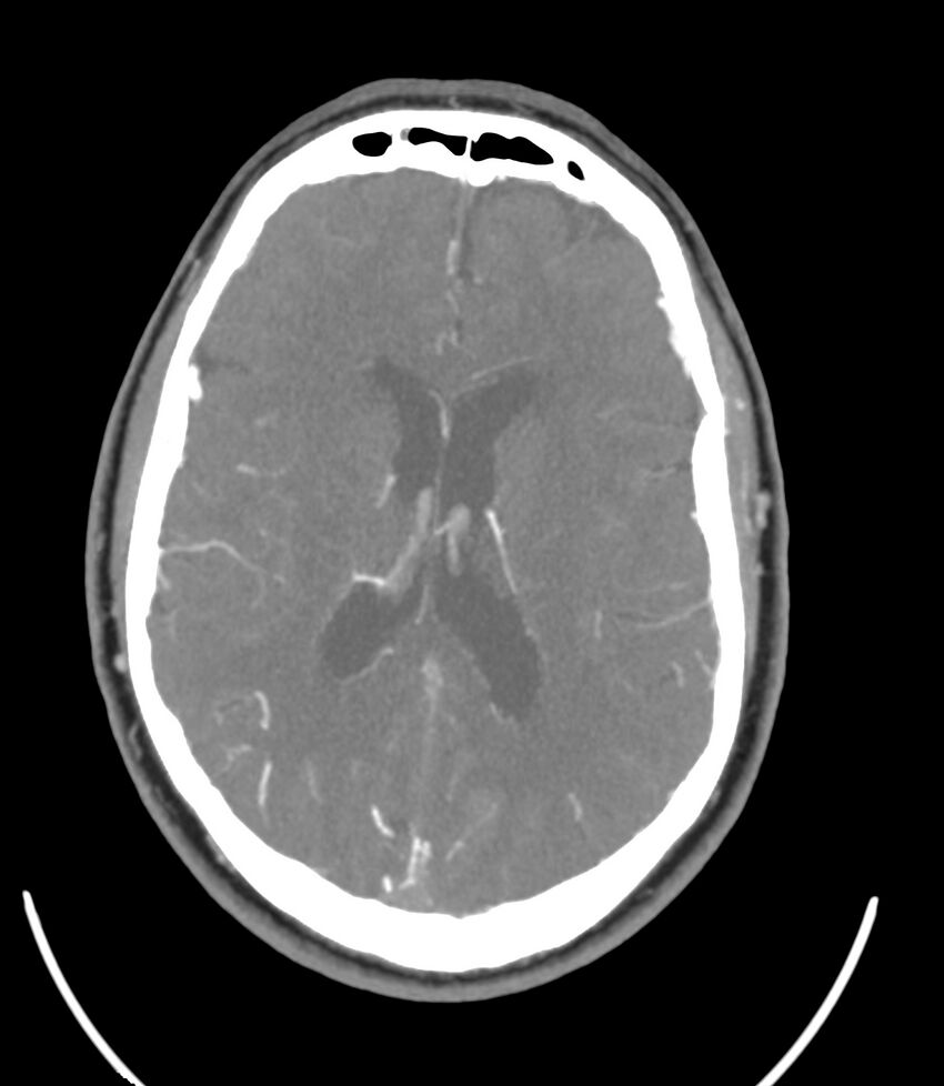 Cerebral dural venous sinus thrombosis (Radiopaedia 86514-102576 A 62).jpg